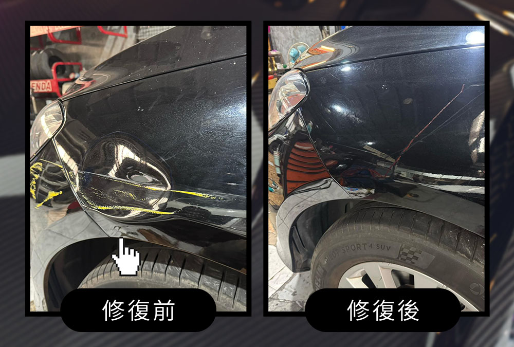 前葉子板凹痕修復