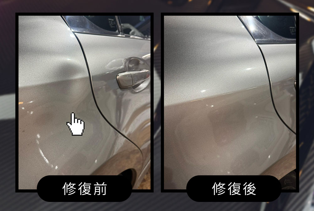 後葉子板凹痕修復